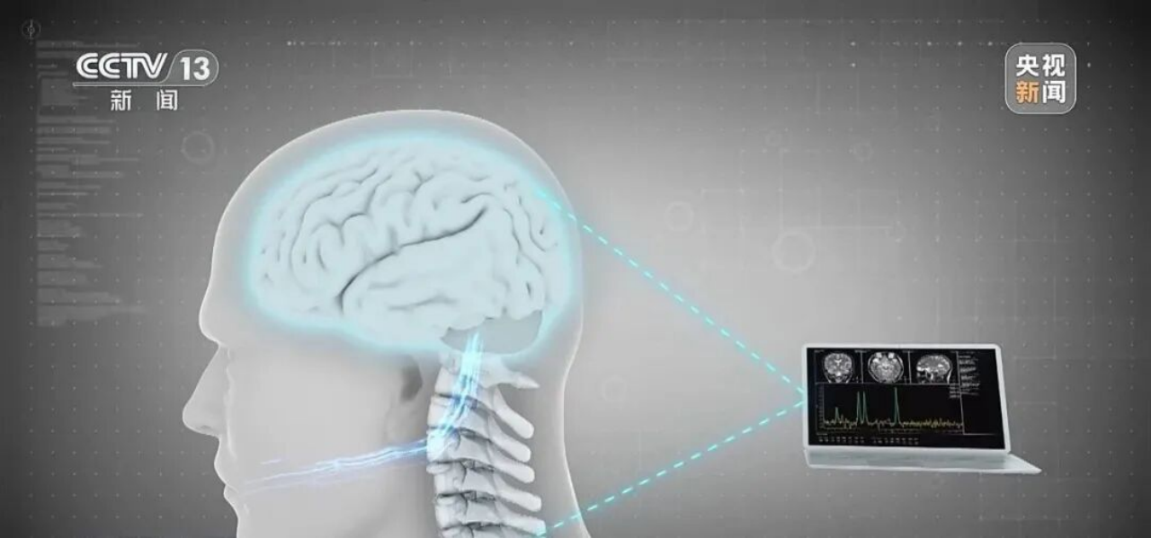 First BCI Prescription Issued in China to Restore Limb Function in Spinal Cord Injury