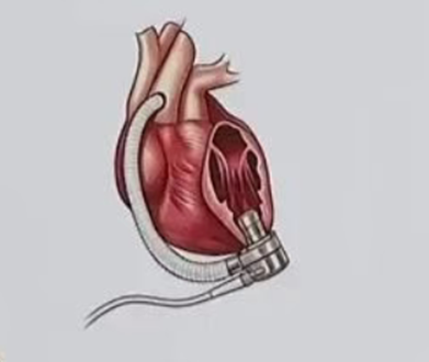 cardiac implantation